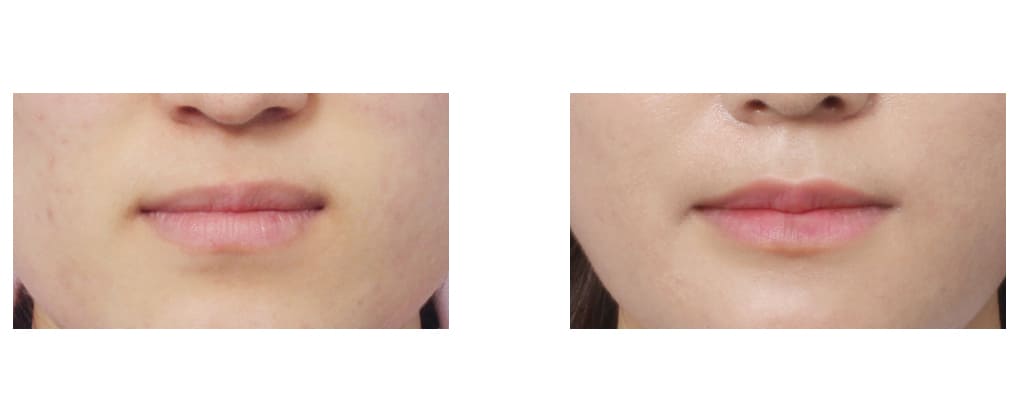 Increasing Lip Volume in Korea