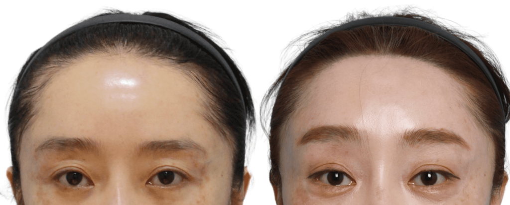 Indications and Contraindications for Forehead Lift in Korea