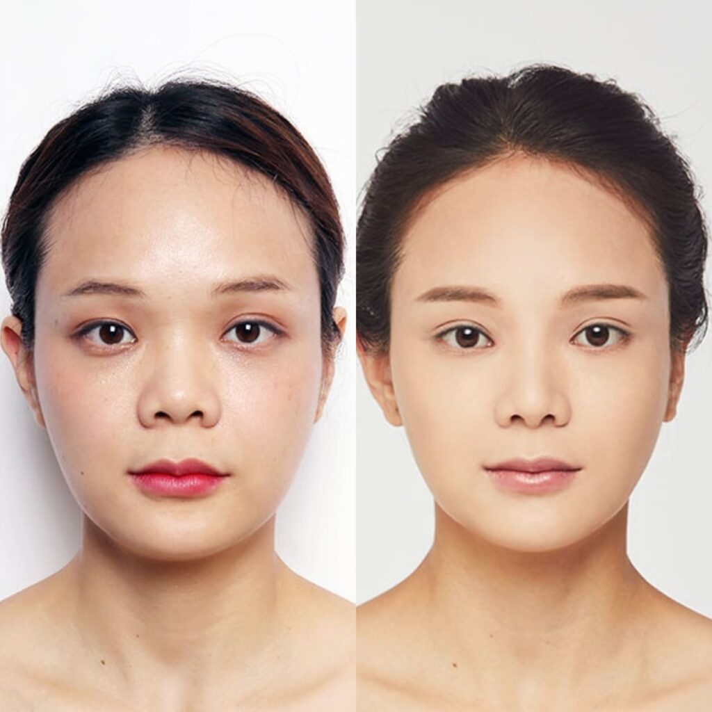 Individualized Asian Rhinoplasty in Korea