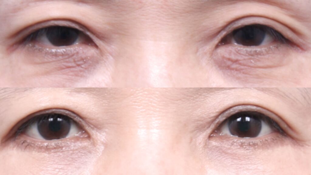 Innovative Approaches to Lower Blepharoplasty in Korea