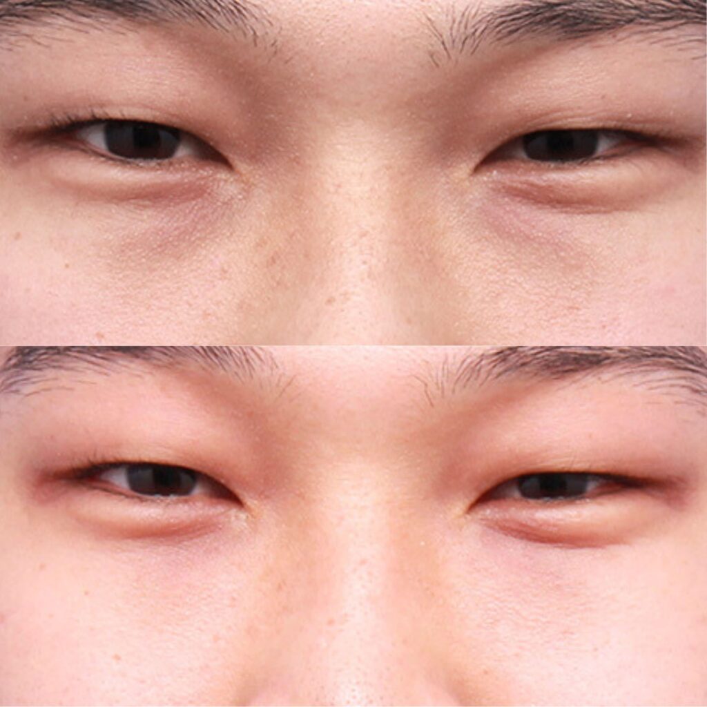 Innovative Eyelid Correction Methods in Korea