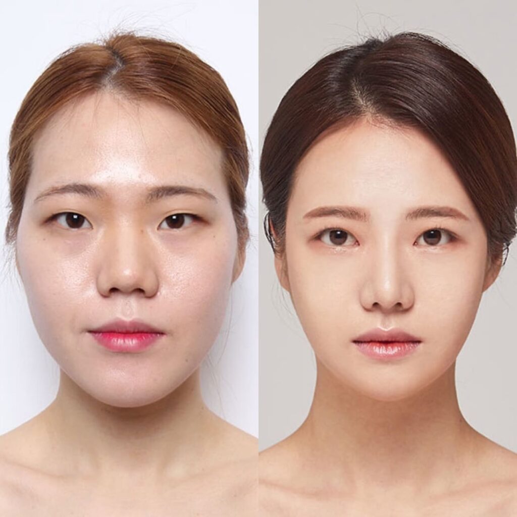 Jaw Reduction Methods for Femininity in Korea