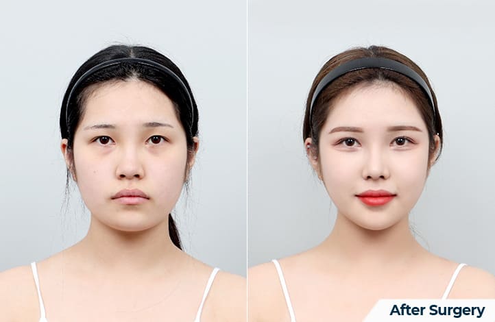 Jaw Transformation_ From Square to V-shaped in Korea