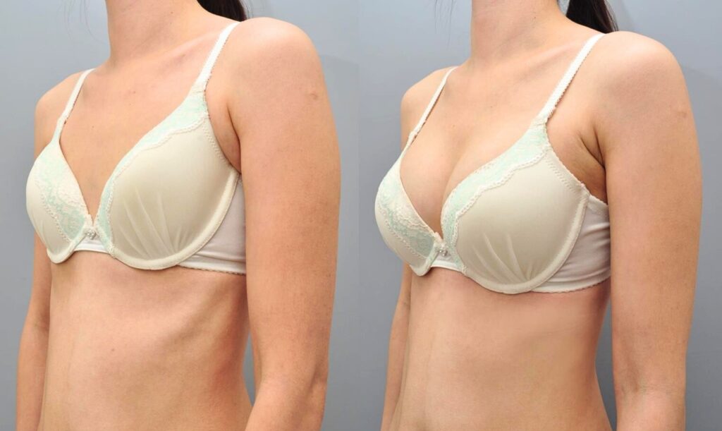 Key Factors for Successful Breast Surgery in Korea