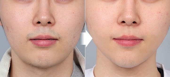 Korean Innovations in Face Lifting