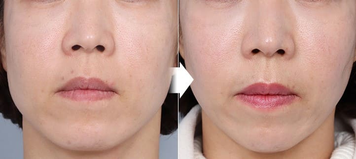 Korean Technologies for Face Lifting