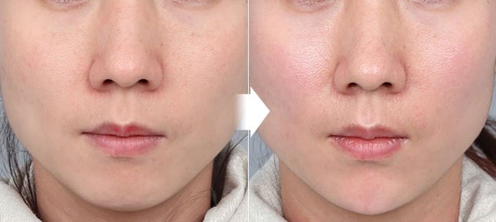 Latest Face Lifting Techniques by Korean Specialists