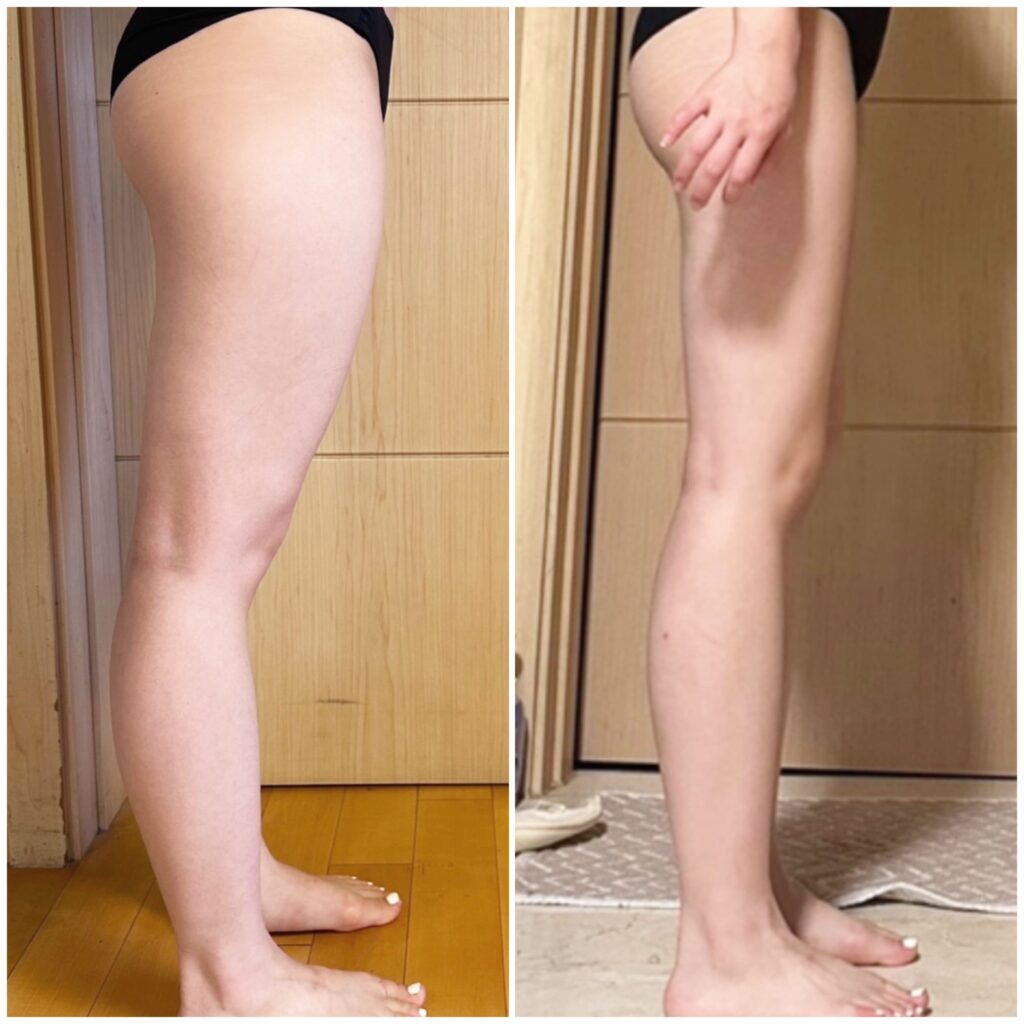 Leg Liposuction Methods in Korea