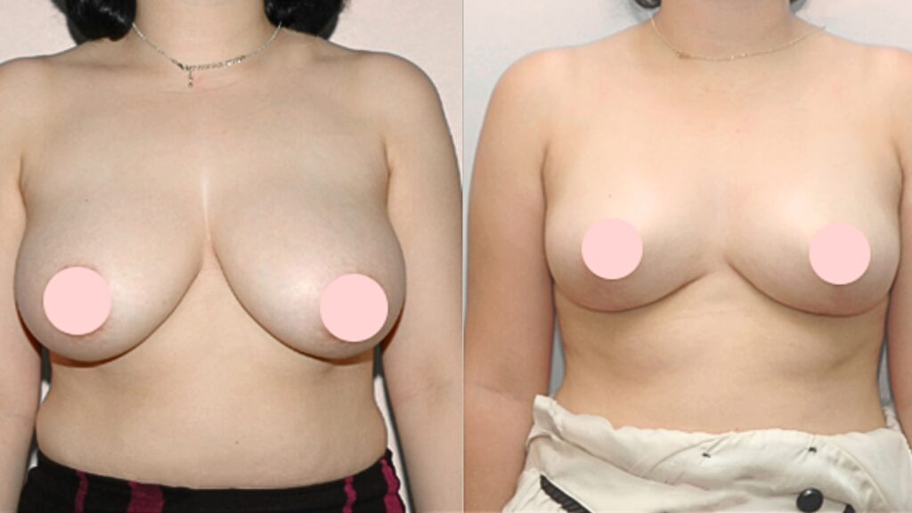 Life After Breast Reduction Surgery