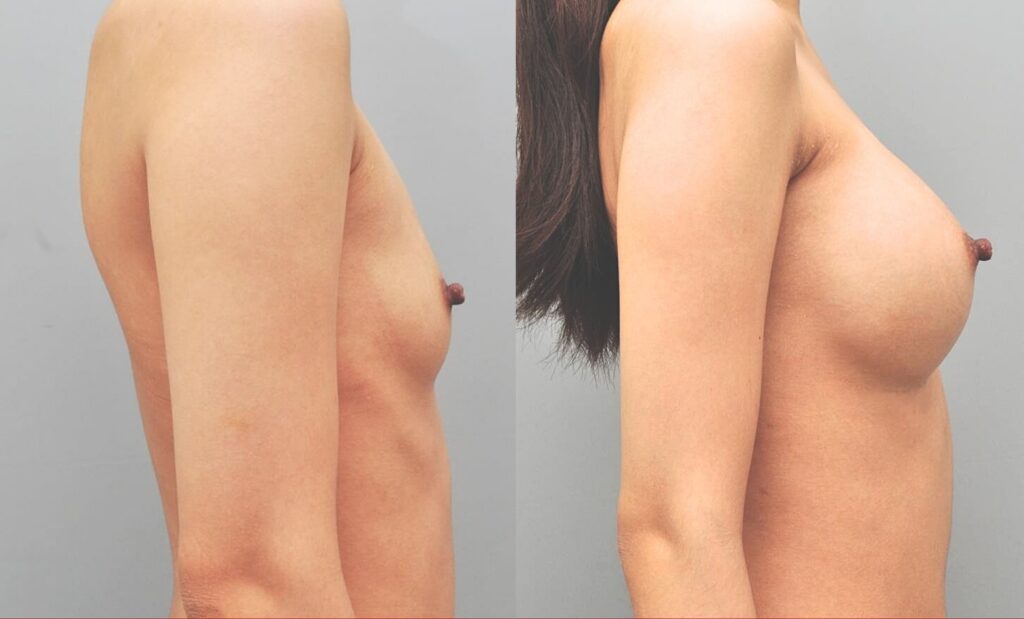 Life Changes Post-Breast Augmentation in Korea