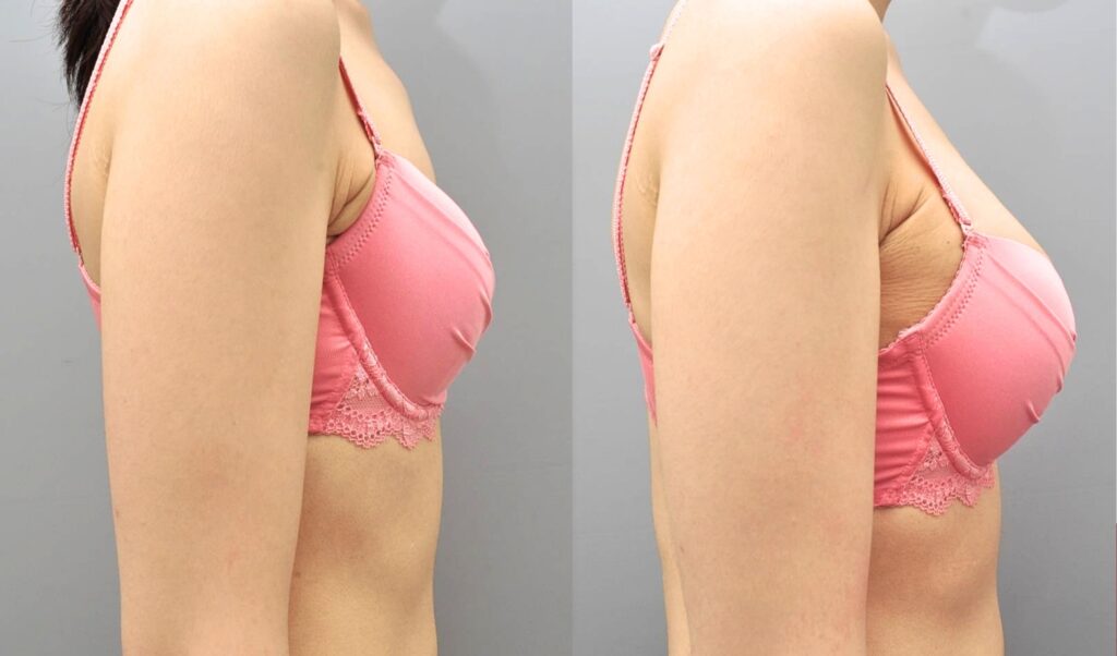 Lifestyle Adjustments after Breast Surgery in Korea