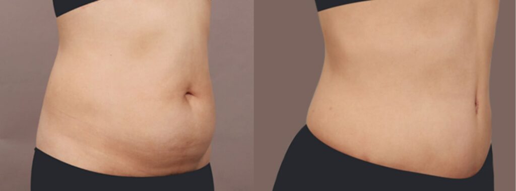 Lifestyle After Abdominoplasty in Korea