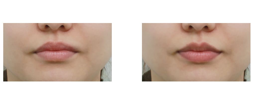 Lip Augmentation for Men and Women in Korea