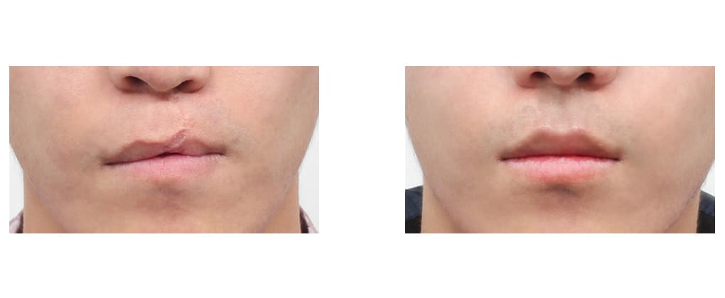 Lip Form Correction in Korea