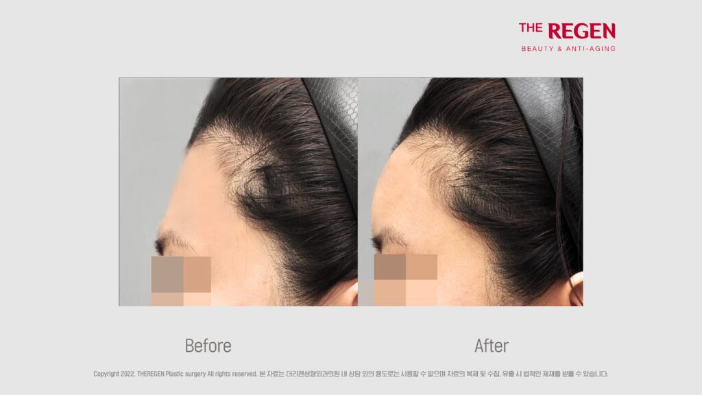 Lipofilling for Cheek Volume Enhancement