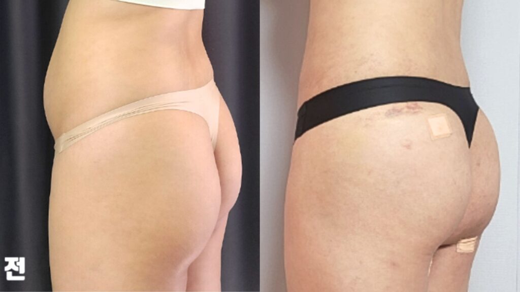 Lipofilling vs Implants for Buttocks in Korea