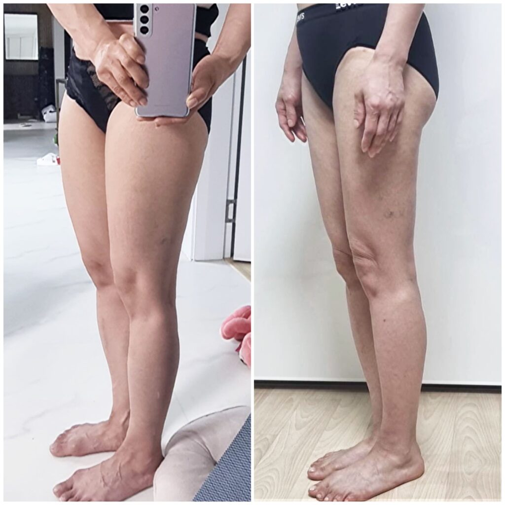 Liposuction for Beautiful Legs in Korea