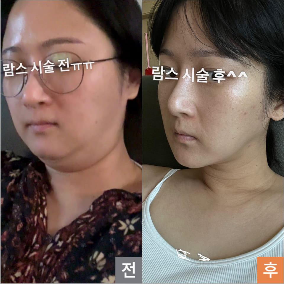 Liposuction for Men and Women in Korea