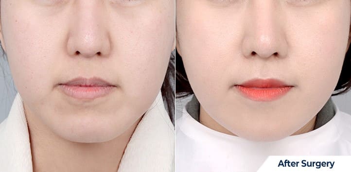 Long-Term Effect Face Lifting Techniques in South Korea