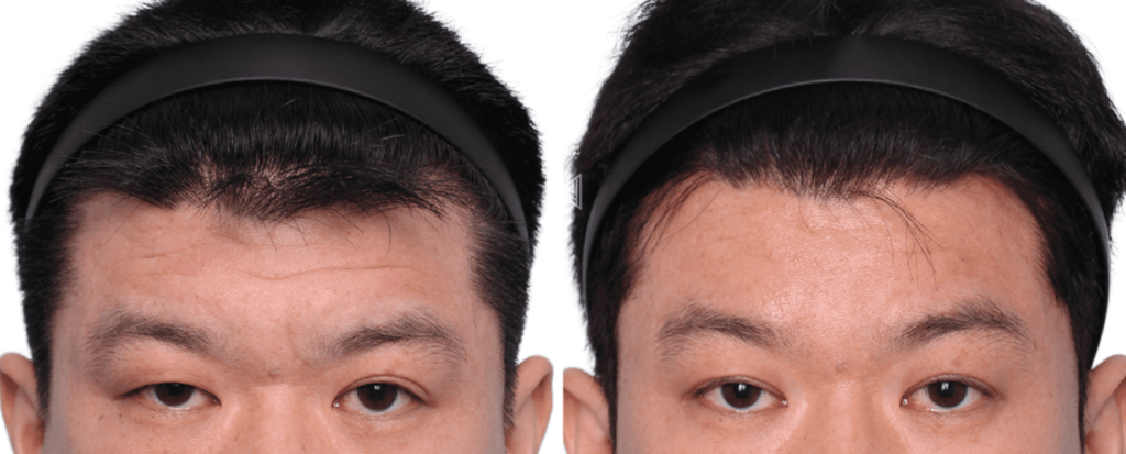 Longevity of Forehead Lift Effects in Korea