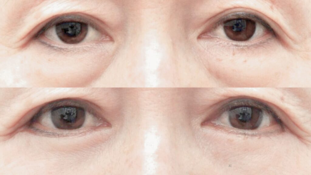 Lower Blepharoplasty for Youth in Korea