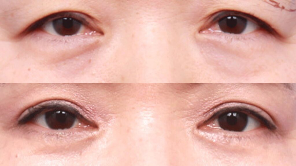 Lower Blepharoplasty_ Basics in Korea