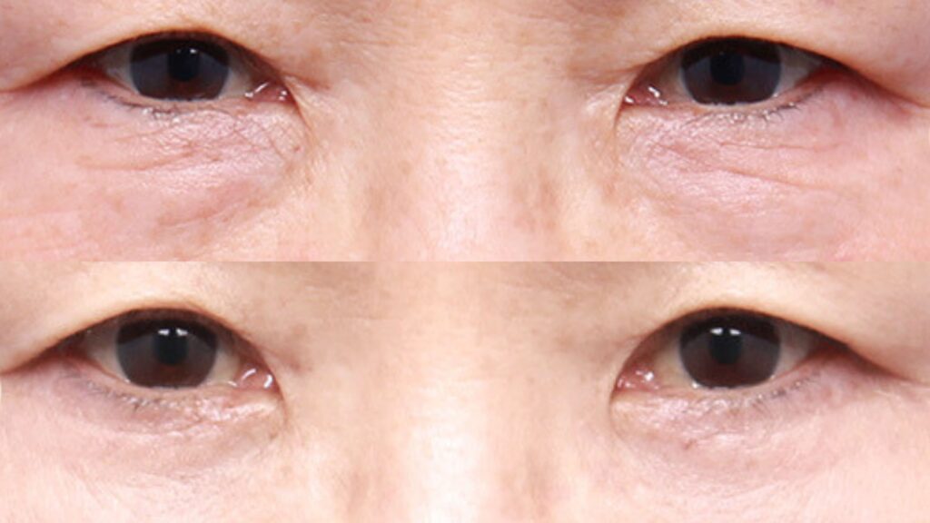 Lower Blepharoplasty_ FAQs in Korea