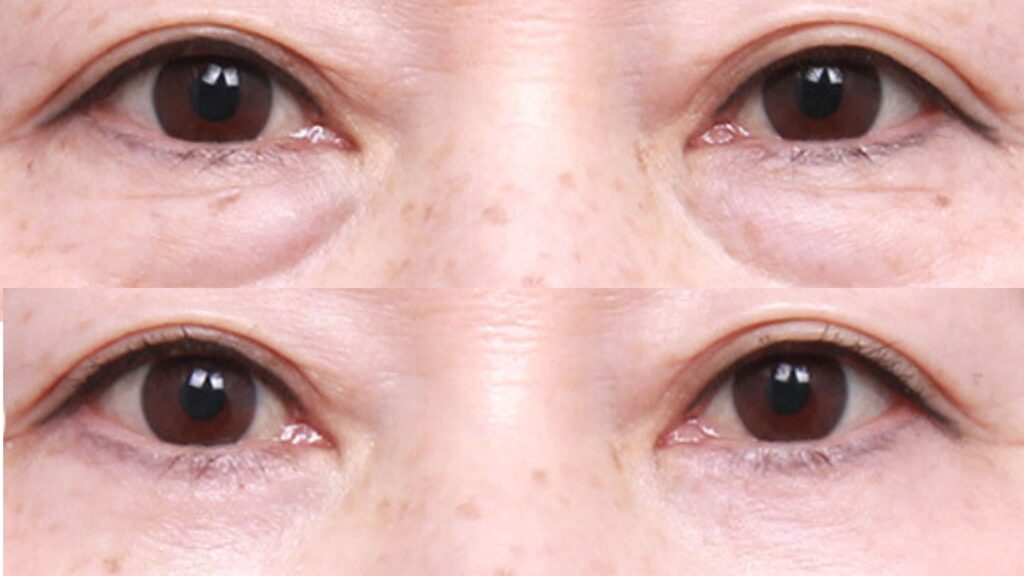 Lower Blepharoplasty_ Step by Step in Korea