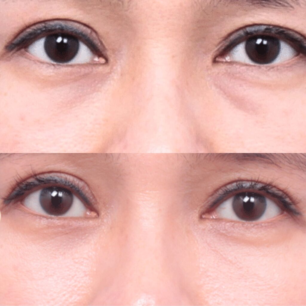 Lower Eyelid Bags Removal Procedure in Korea