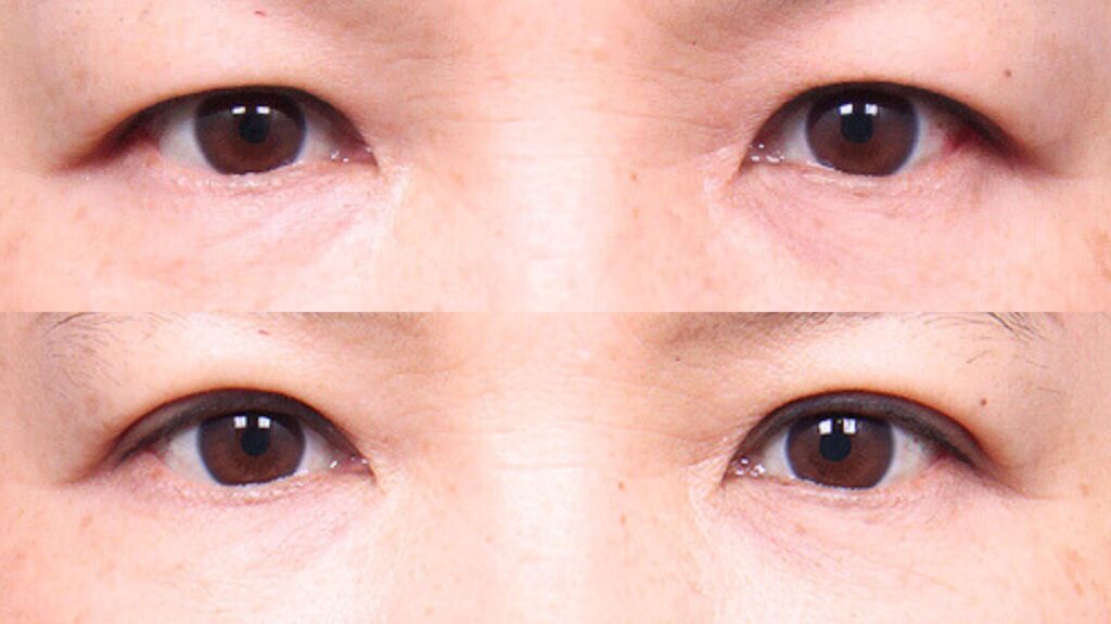 Lower Eyelid Lift_ Modern Trends in Korea