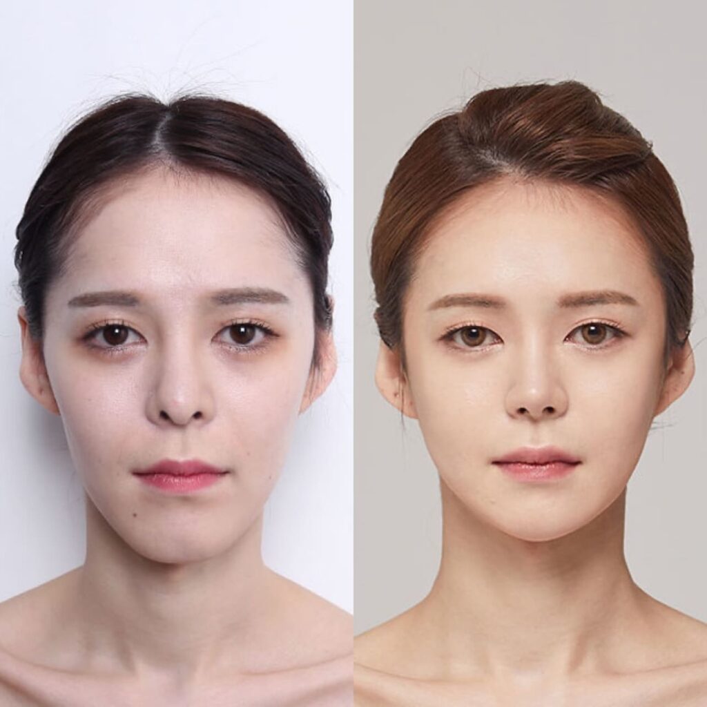 Lower Face Correction for Elegance in Korea