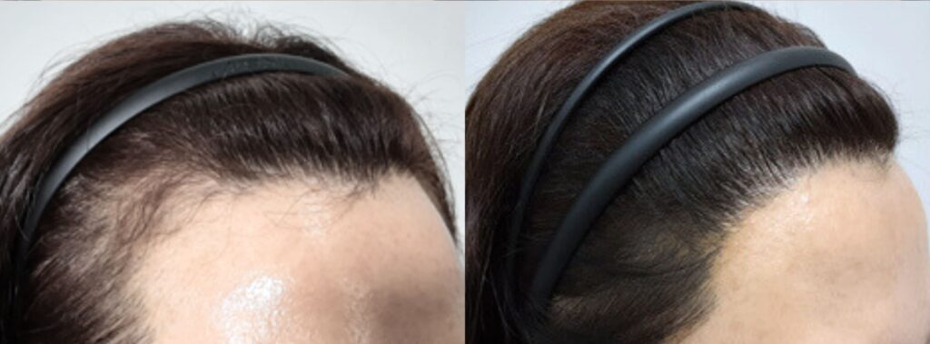 Magic of hair transplant for women in Korea