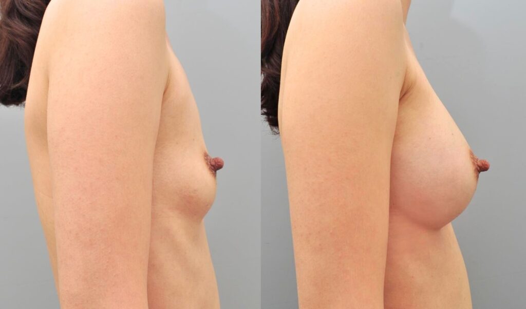 Maintaining Shape after Augmentation in Korea