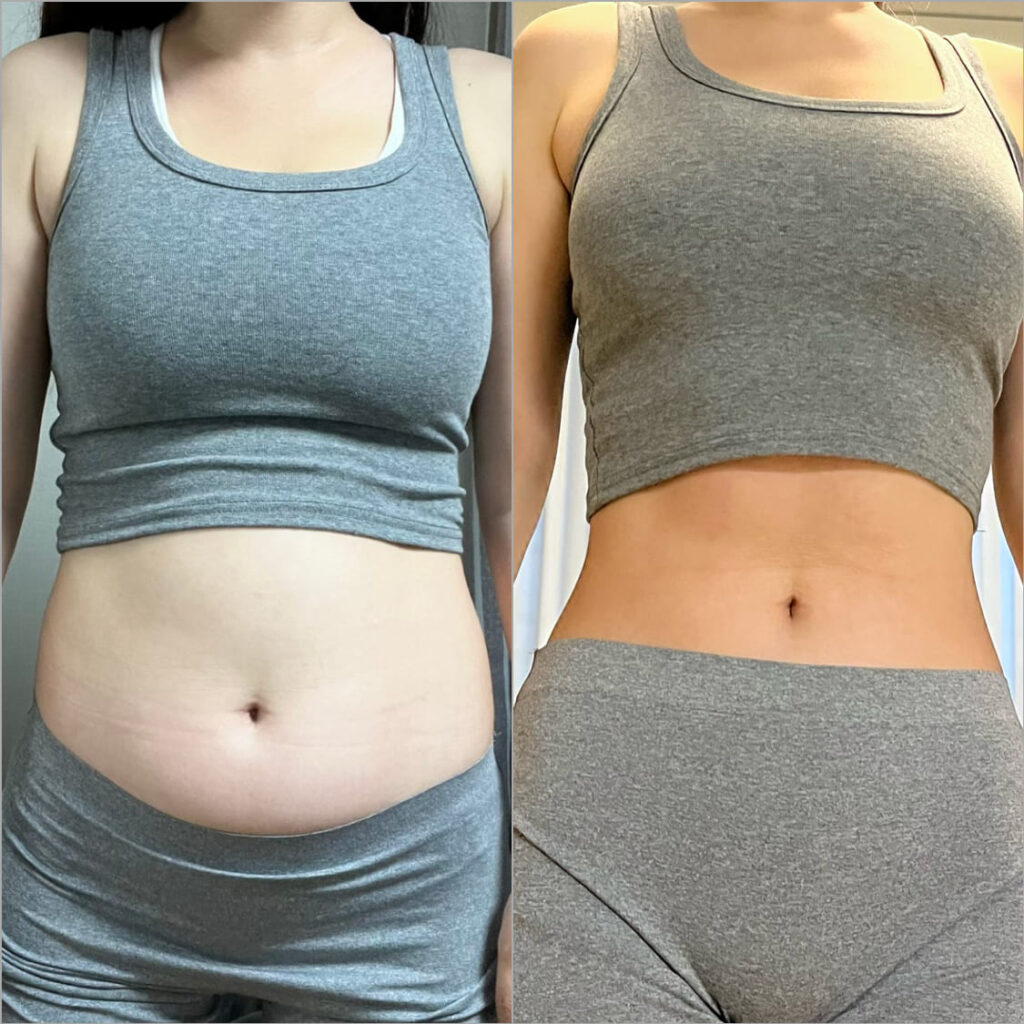 Male Abdominal Liposuction in Korea