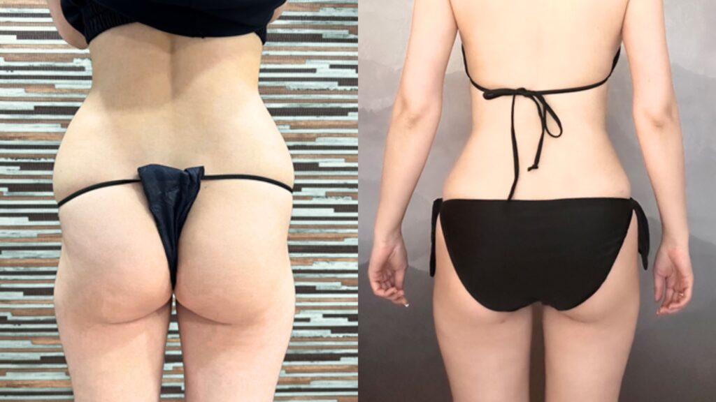 Massage Techniques Post-Lipofilling of Buttocks in Korea