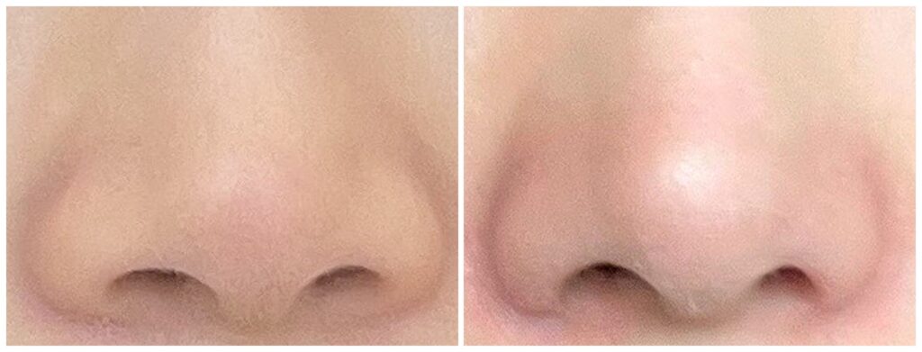 Massage for Nasal Wing Reduction_ Effectiveness and Benefits in Korea