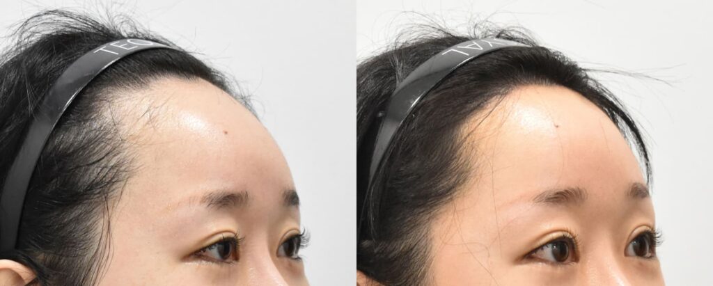 Methods for Reducing Forehead Height in Korea