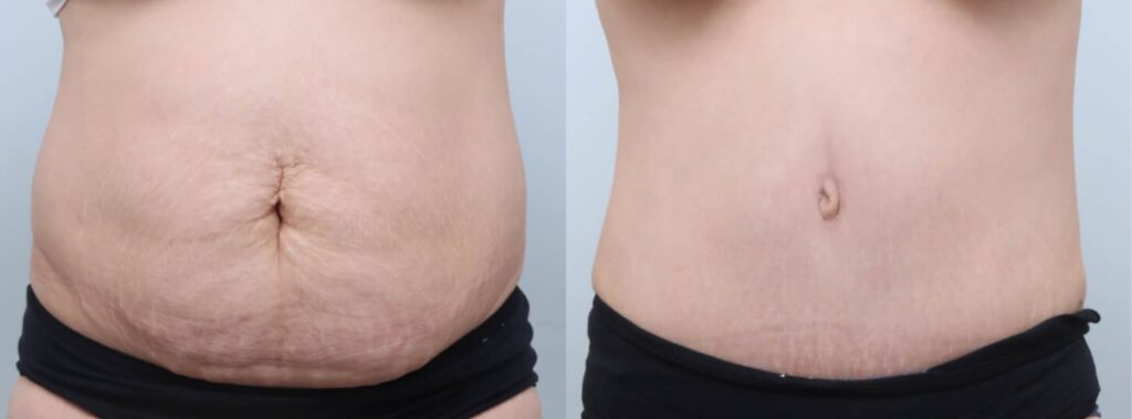 Mini-Abdominoplasty in Korea