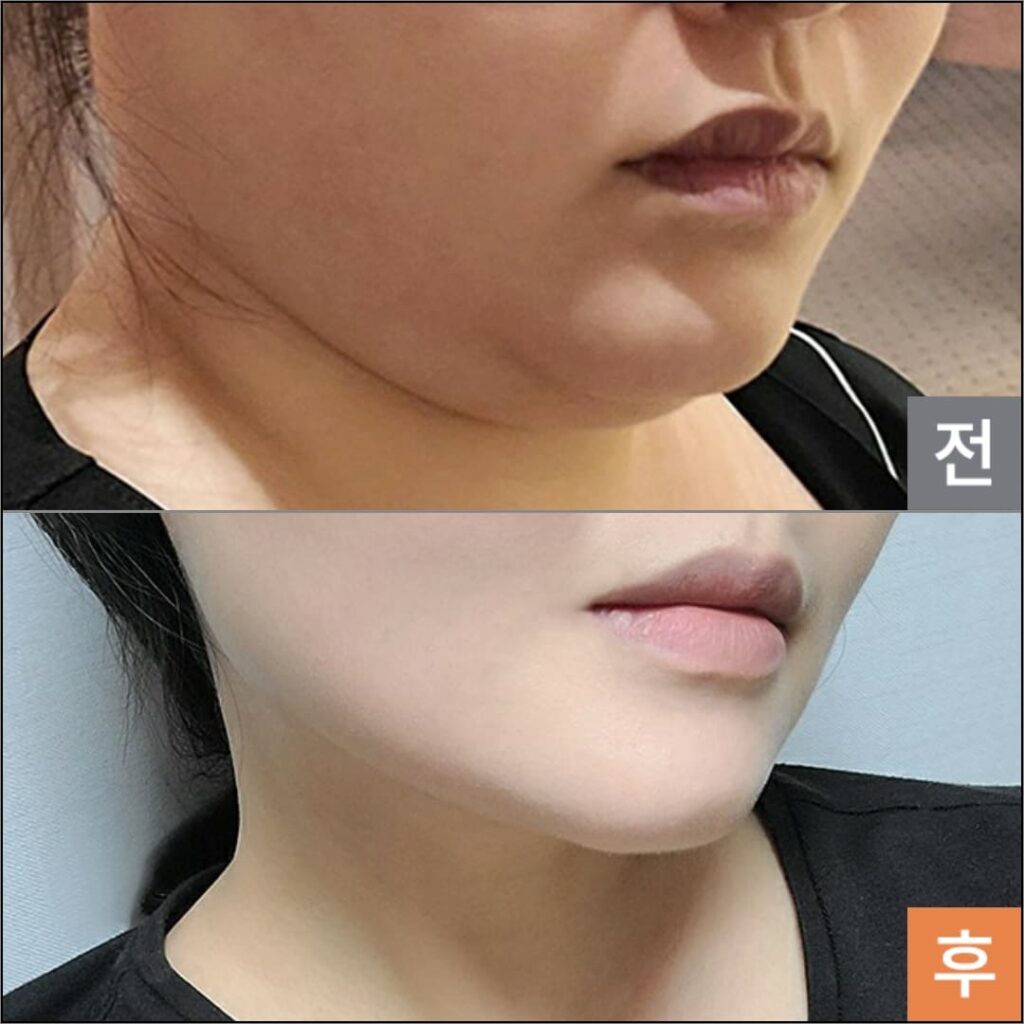 Mini-Liposuction for Facial Rejuvenation in Korea