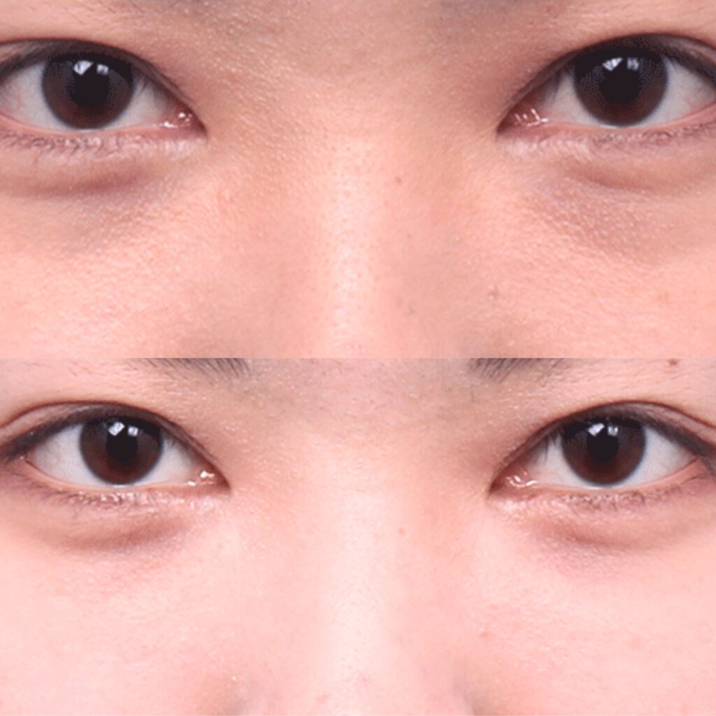 Minimally Invasive Eyelid Surgery in Korea