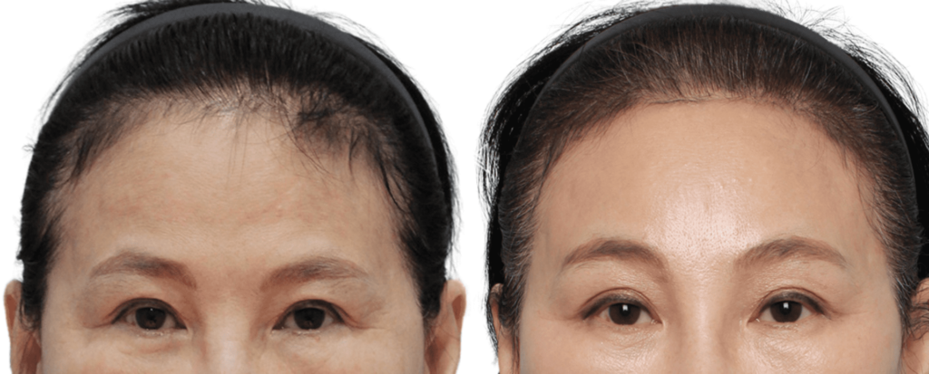 Minimally Invasive Forehead Lift in Korea