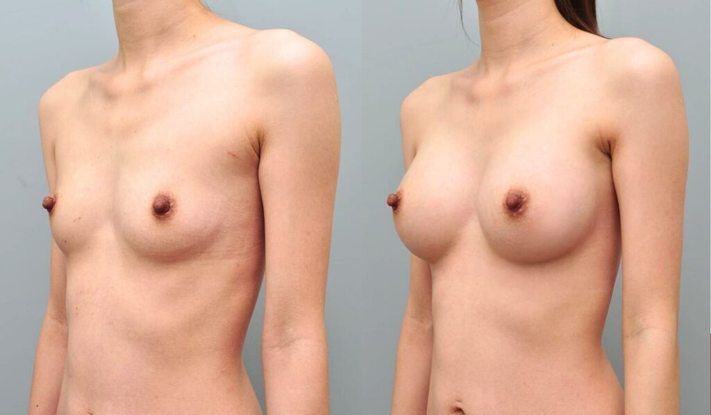 Minimizing Complications in Breast Augmentation in Korea