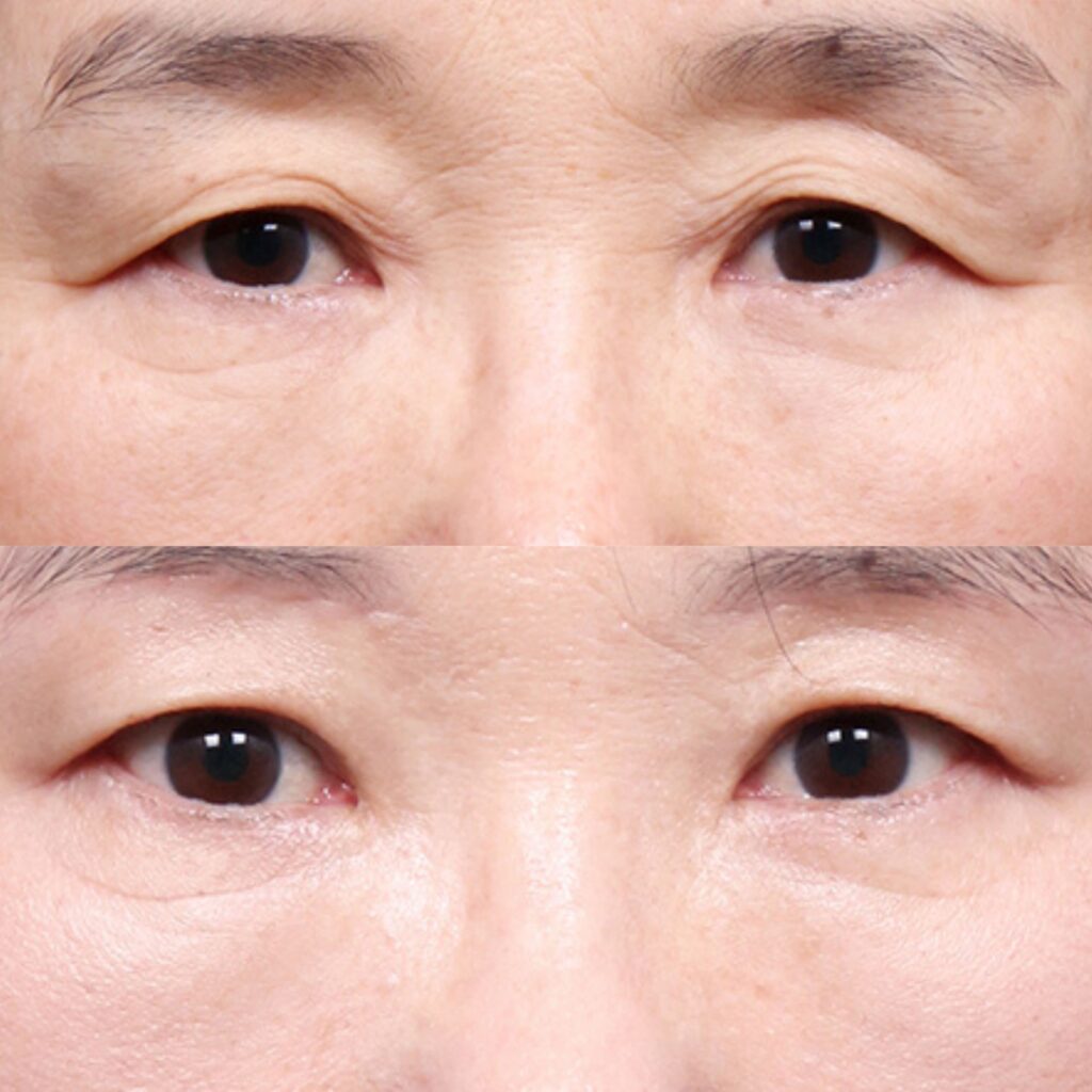 Modern Eyelid Lift Methods in Korea