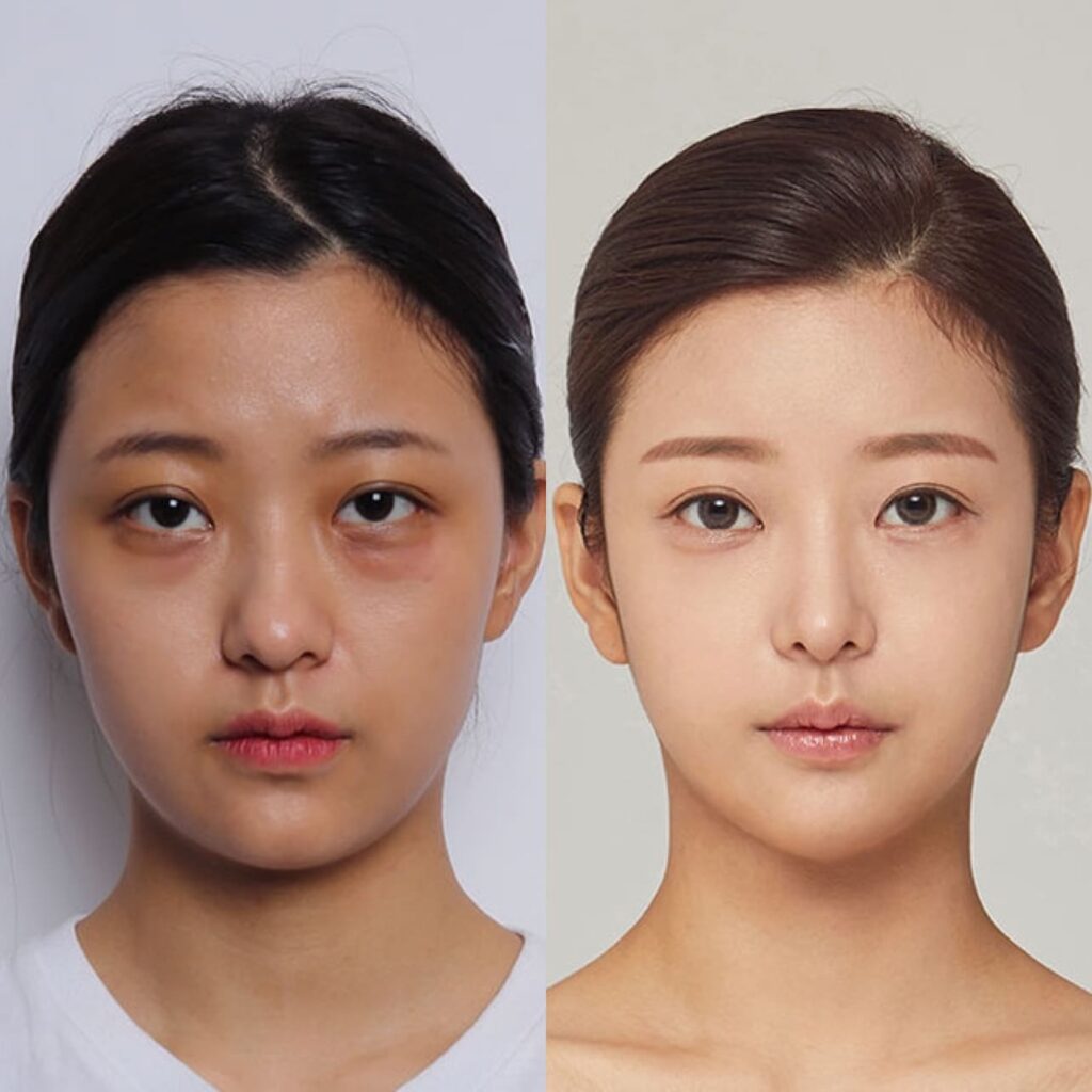 Modern Rhinoplasty for Asians in Korea