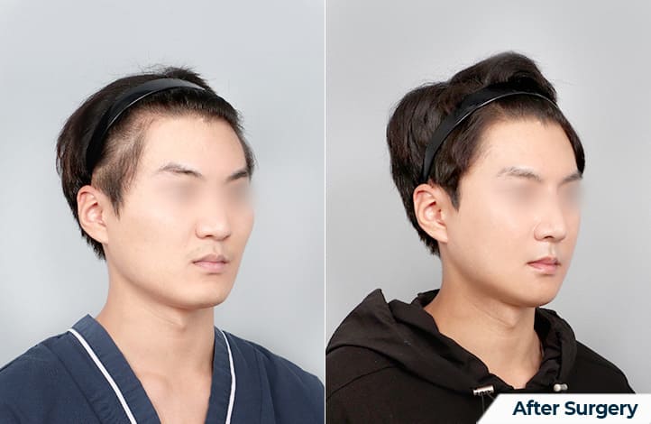 Modern Techniques in Cheek Correction in Korea