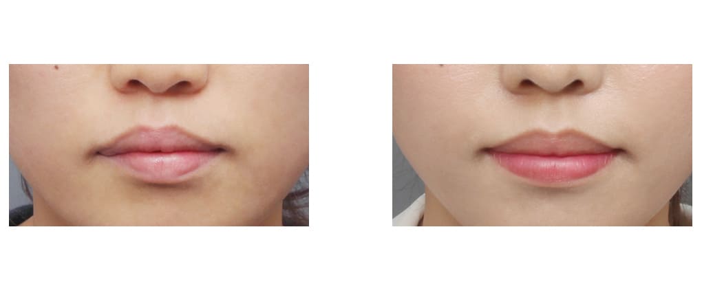 Modern Techniques in Lip Enhancement in Korea