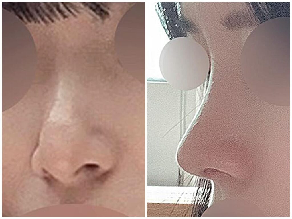 Nasal Rehabilitation in Korea