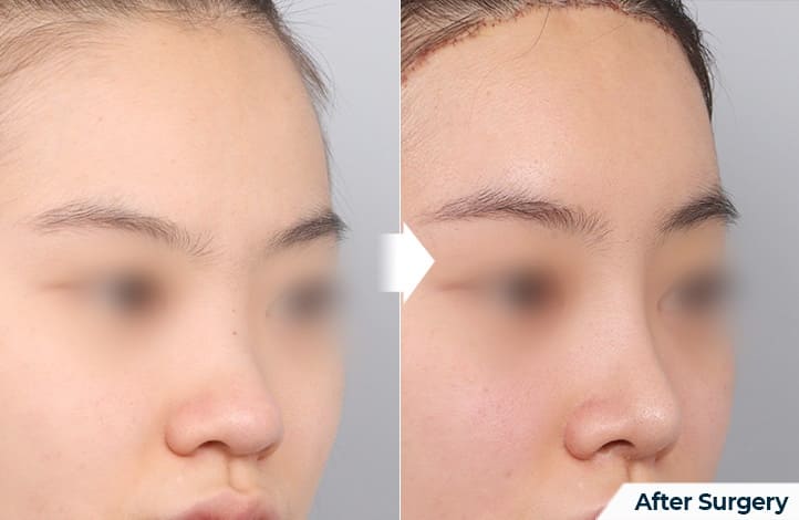 Nasal Shape Treatment in Korea