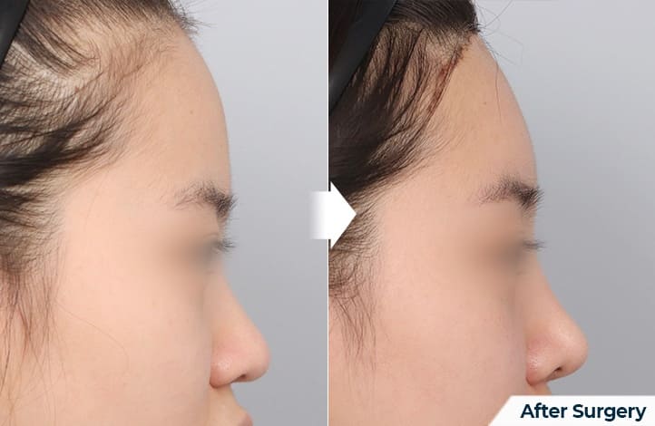 Nasal Tip Plastic Surgery in Korea