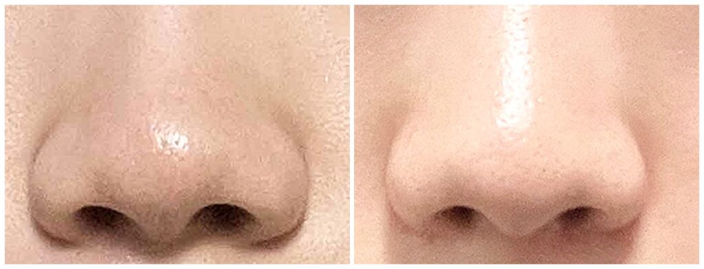 Nasal Wing Reduction in Men and Women_ What Differs in Korea